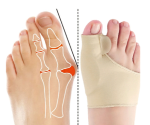 Elastyczne opaski na haluksa (2 sztuki)